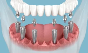 Dantų implantavimas
