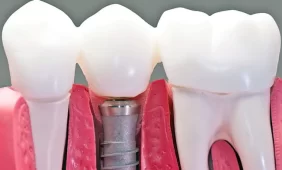 All-on-4 – tobula šypsena be chirurgijos pasekmių