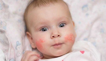 Kūdikių oda ir atopinis dermatitas