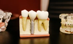 Dantų implantai tarnauja