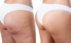 Celiulitas