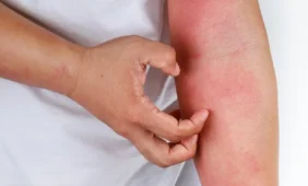 Kas gali pakeisti gyvenimą su atopiniu dermatitu?