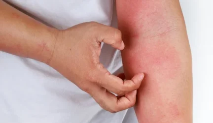 Kas gali pakeisti gyvenimą su atopiniu dermatitu?
