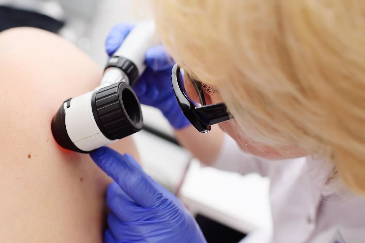 Melanoma – tyli, bet grėsminga odos liga