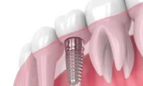 Vienmomentės dantų implantacijos privalumai