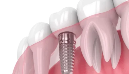 Vienmomentės dantų implantacijos privalumai