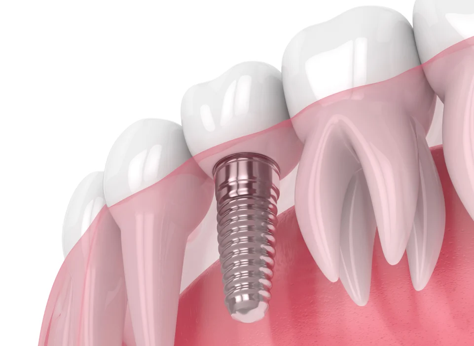 Vienmomentės dantų implantacijos privalumai