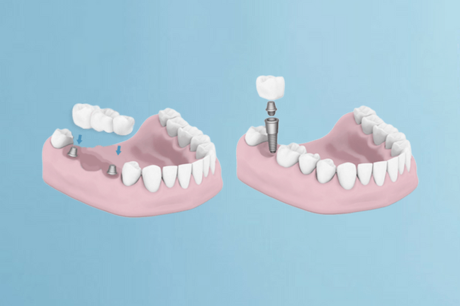 Dantų implantavimasVilniuje