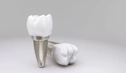 Dantų implantų kaina bei jų rūšys