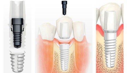 Bemetalis cirkonio implantas – išpildyta utopinė svajonė