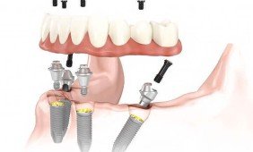 Dantų implantų metodika "All on 4": kokie jos privalumai?