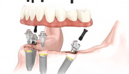 Dantų implantų metodika "All on 4": kokie jos privalumai?