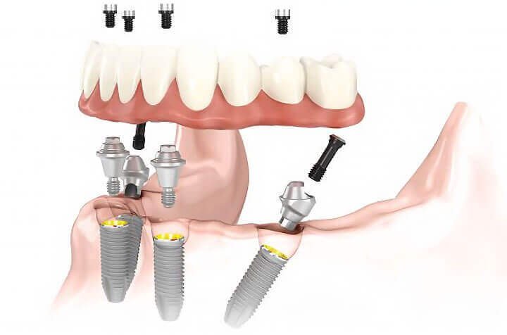 Dantų implantų metodika "All on 4": kokie jos privalumai?