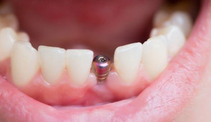 Žymiausi dantų implantų gamintojai