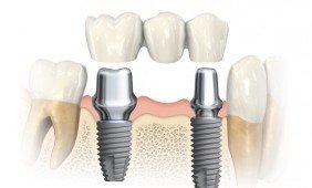 Kodėl sunku rasti tikslią dantų implantacijos kainą?
