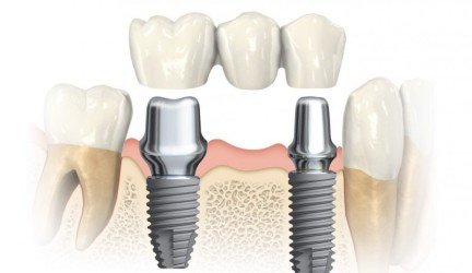 Kodėl sunku rasti tikslią dantų implantacijos kainą?