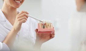 Ką reikia žinoti apie dantų implantavimo klinikos pasirinkimą?