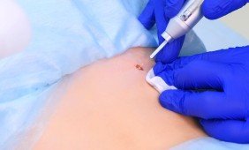 Lazerinės dermatologijos klinika Skin Olympus – gerybinių odos darinių šalinimas lazeriu yra efektyvus ir saugus