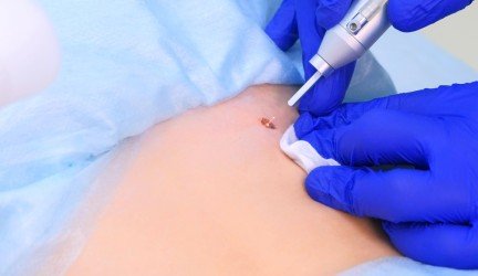 Lazerinės dermatologijos klinika Skin Olympus – gerybinių odos darinių šalinimas lazeriu yra efektyvus ir saugus