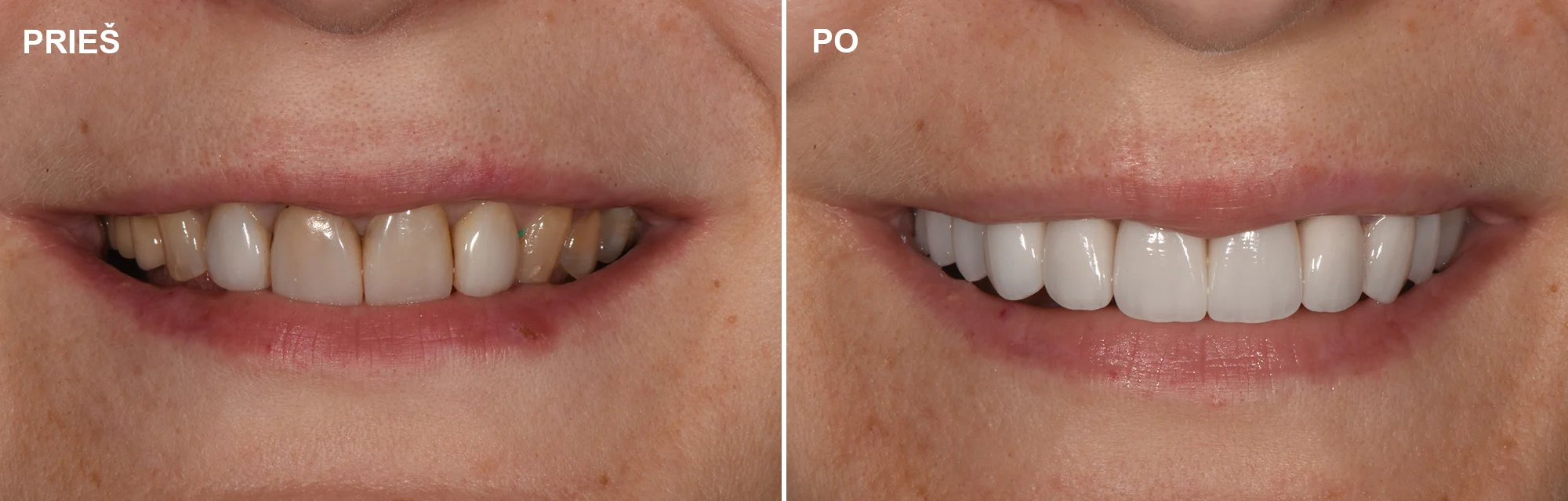 Stipriai spalvą pakeitusių viršutinio žandikaulio dantų protezavimas Cirkonio keramikos vainikėliais