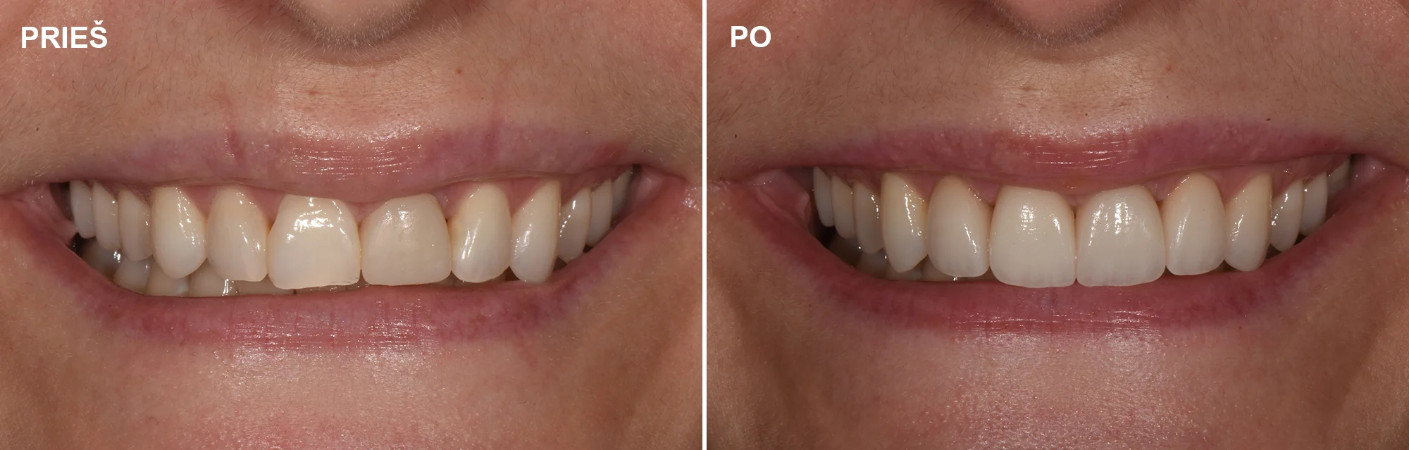 Keturių priekinių dantų restauravimas laminatėmis
