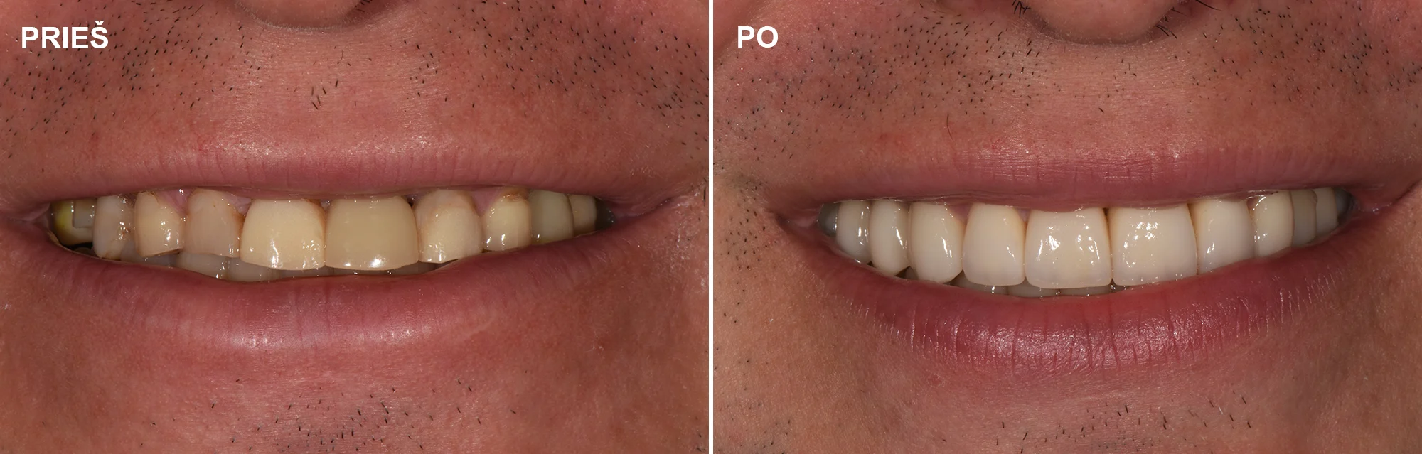 Priekinio danties implanto ir visų nudilusių, neestetiškų dantų atstatymas Cirkonio keramikos vainikėliais