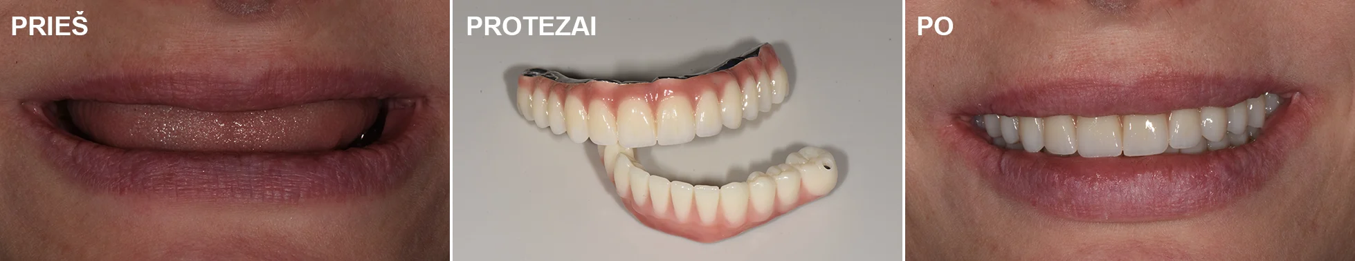 Pilnai bedančių žandikaulių restauravimas Cirkonio keramikos protezais fiksuotais ant implantų