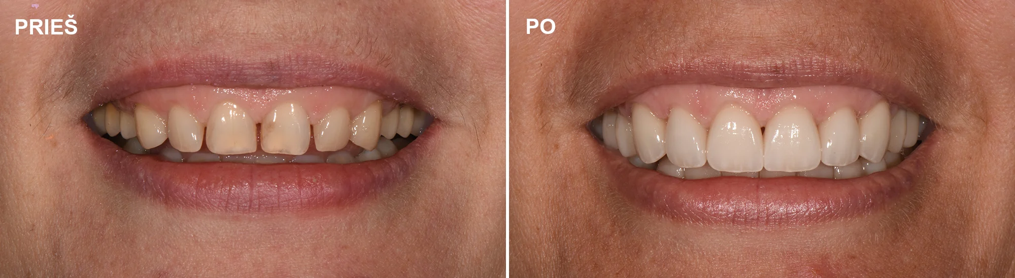 Priekiniai dantys protezuoti Emax keramikos laminatėmis 