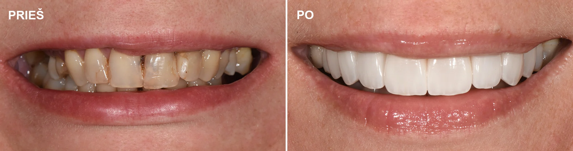 Stipriai pažeistų dantų restauravimas Emax keramikos vainikėliais