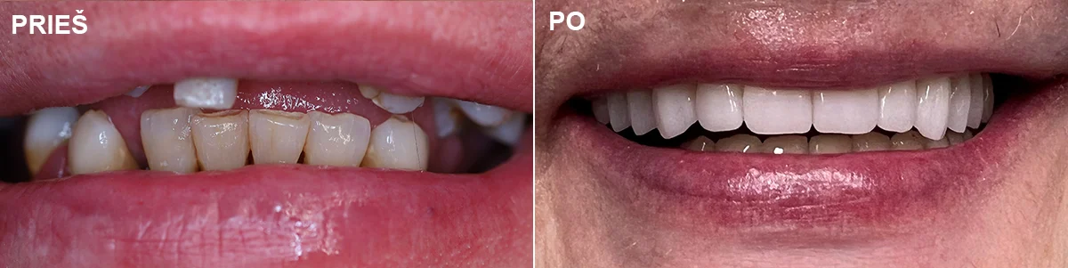 Chirurgija – gyd. Dalius Matkevičius Protezavimas – gyd. Kristina Gegeckaitė Klinika „Ortodenta“