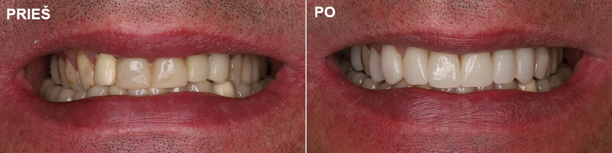 Protezavimas - gyd. Kristina Gegeckaitė Estetinė dantenų plastika - gyd. Nomeda Miknevičienė Estetinis plombavimas - Gyd. Gabrielė Slušinskienė Klinika „Ortodenta“