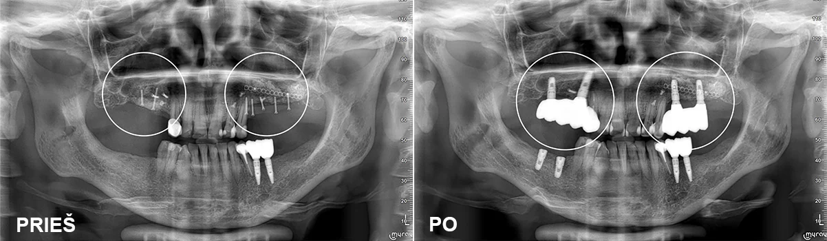 Chirurgija – gyd. Dalius Matkevičius Protezavimas – gyd. Kristina Gegeckaitė Klinika „Ortodenta“