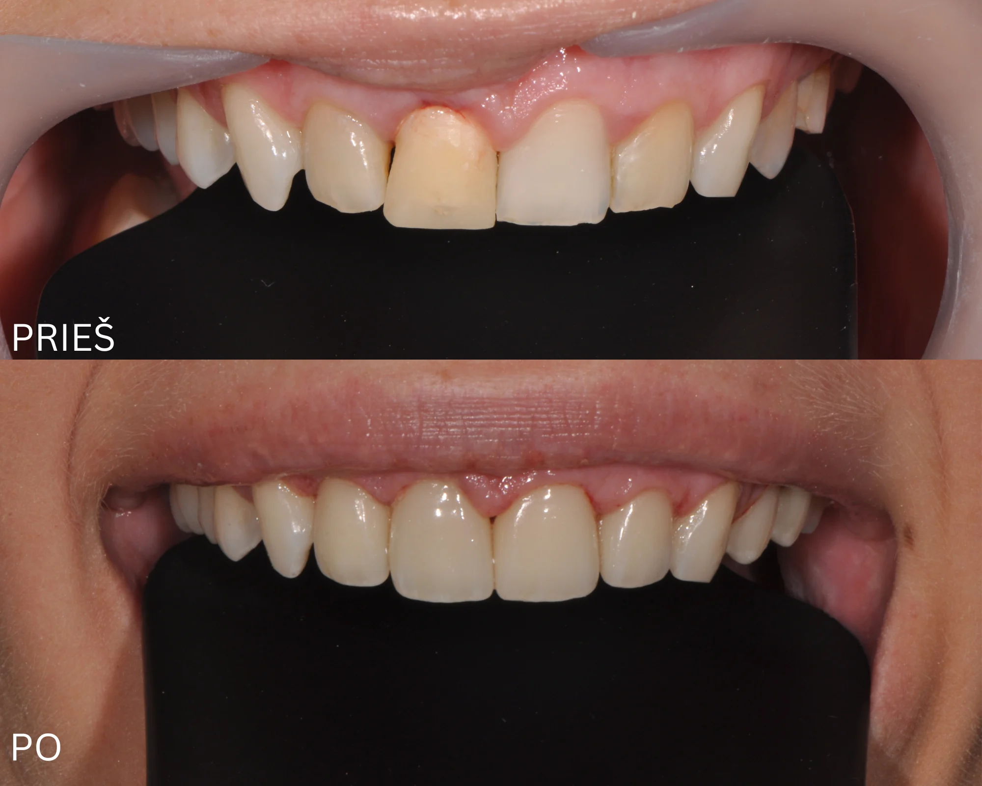 4 dantų estetinis protezavimas laminatėmis