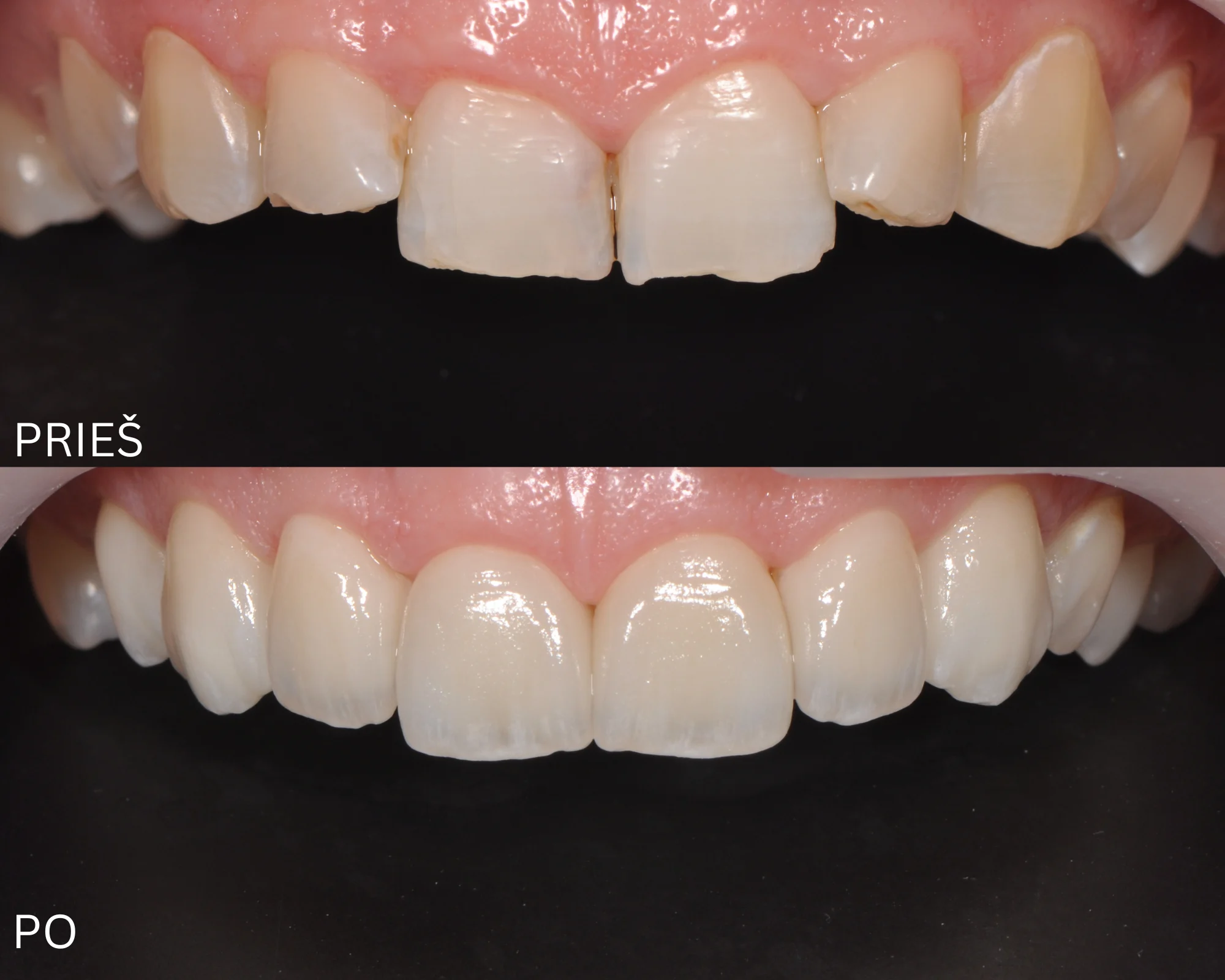 6 dantų estetinis protezavimas laminatėmis