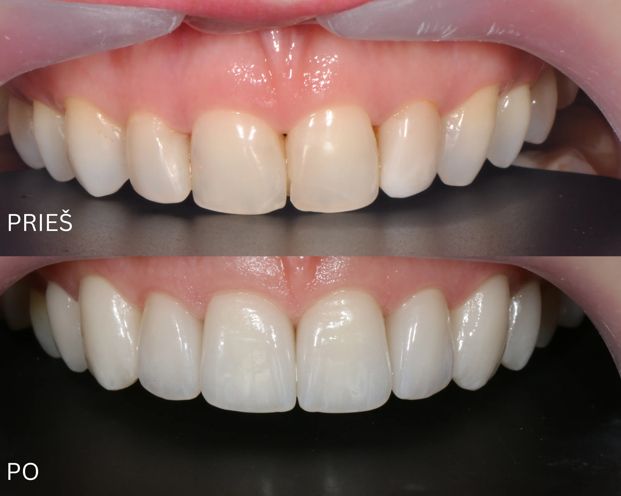8 dantų estetinis protezavimas laminatėmis