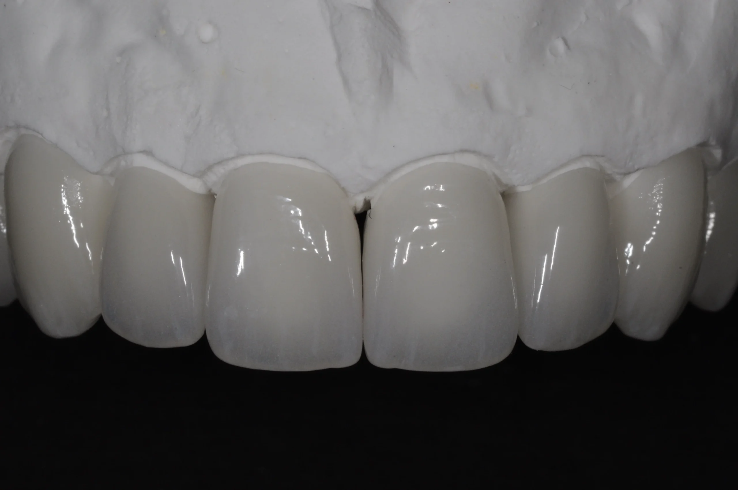 Laminatės prieš cementavimą ant dantų modelio