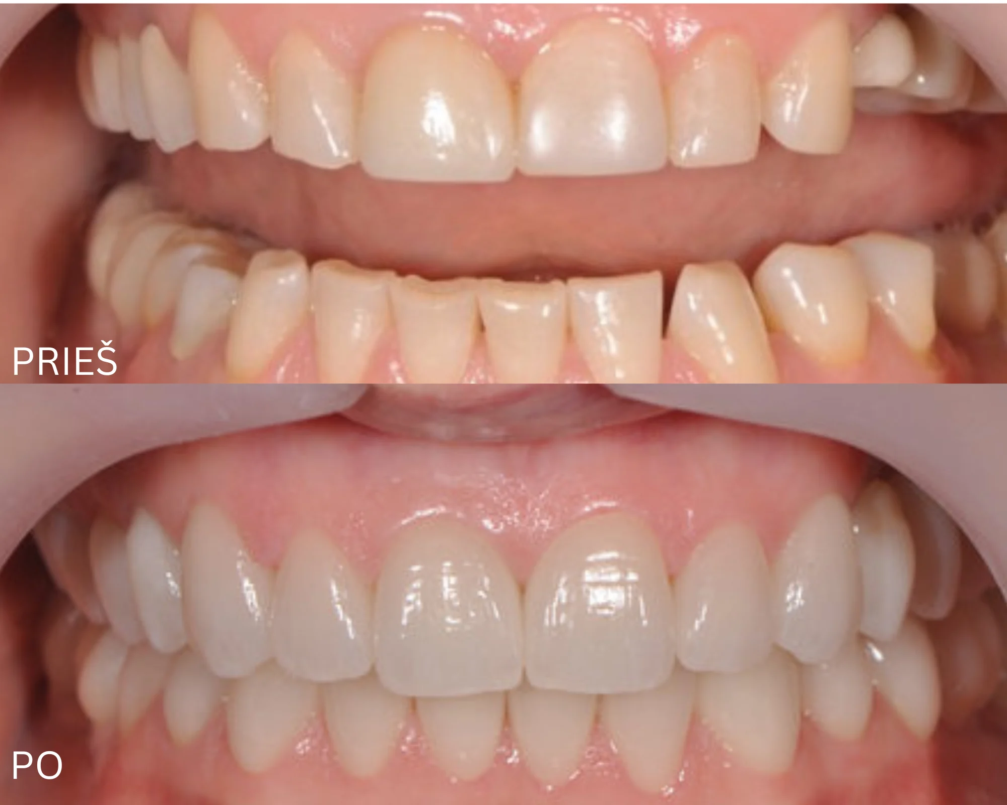 Šypsenos rekonstrukcija laminatėmis ir vainikėliais