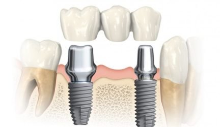 Dantų implantacija