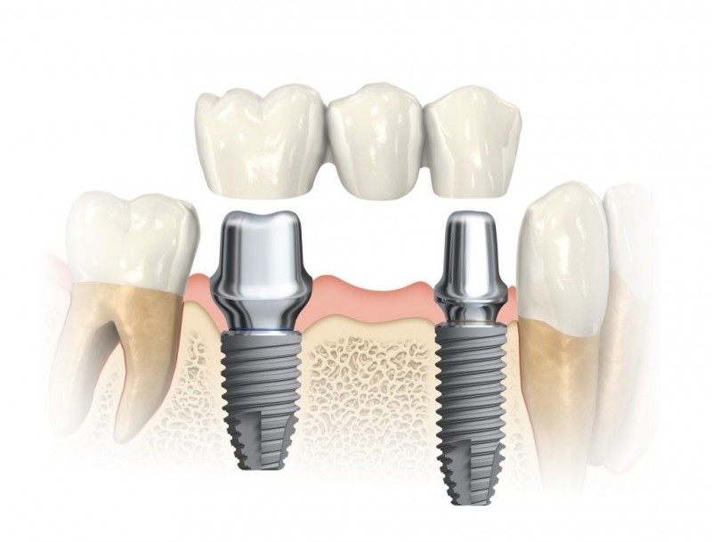Dantų implantacija