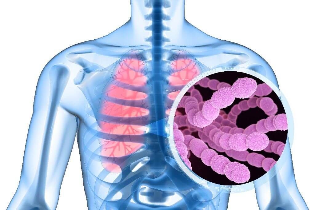 Pneumokokas