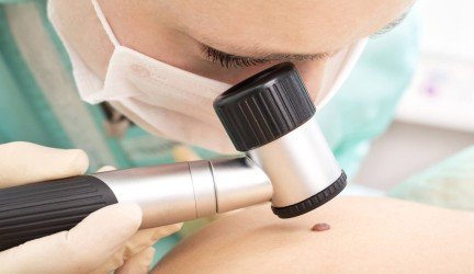 melanoma