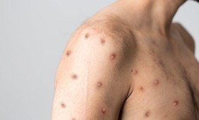 Įprasti simptomai gali reikšti naują pasaulyje plintantį virusą: kaip apsisaugoti?