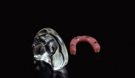 skaitmeninė implantacija