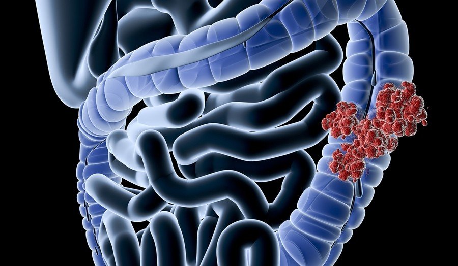 Tiesiosios žarnos gydymas