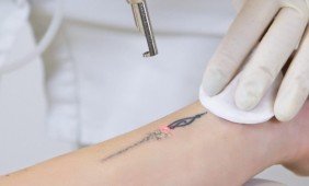 Tatuiruočių ir permanentinio makiažo šalinimas
