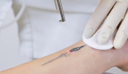 Tatuiruočių ir permanentinio makiažo šalinimas