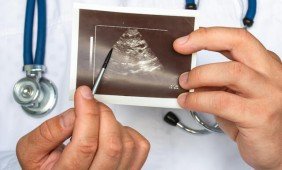 Policistinių kiaušidžių sindromas