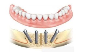 Visi dantys ant 4 implantų kaina