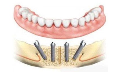 Visi dantys ant 4 implantų kaina