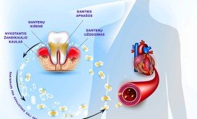Periodontitas